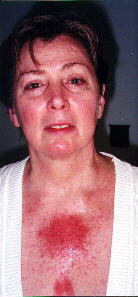 Rash